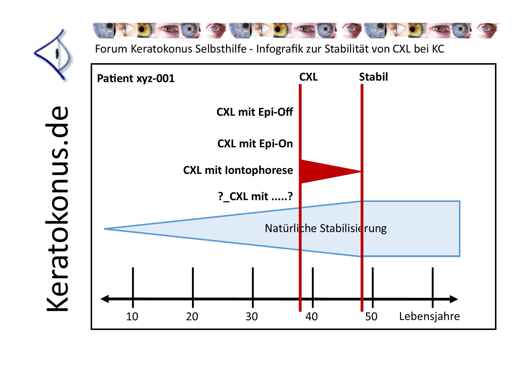 KC   copyright by Keratokonus de   how long lasts clx 001   pt01