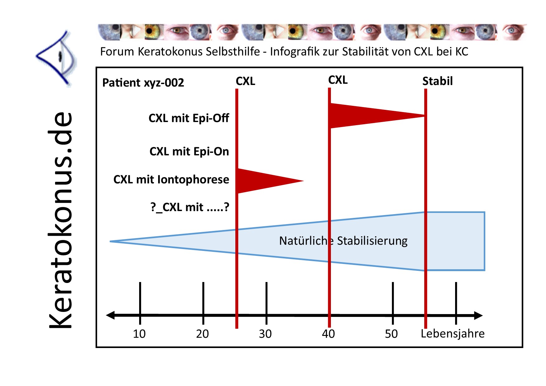 KC   copyright by Keratokonus de   how long lasts clx 001   pt02