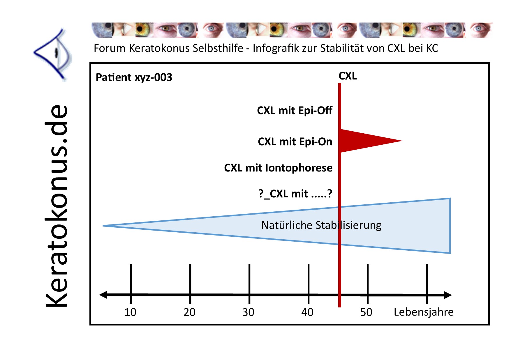 KC   copyright by Keratokonus de   how long lasts clx 001   pt03